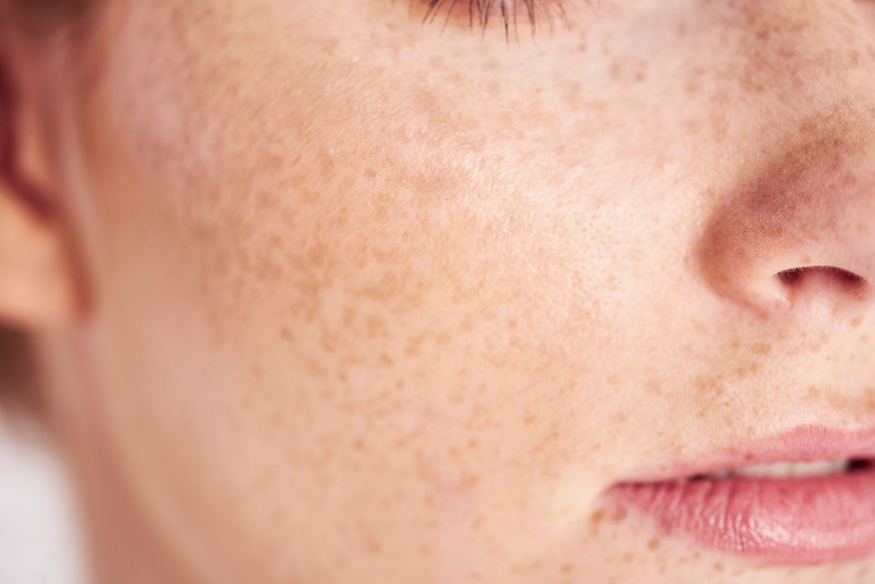 Sunspots: What Is the Cause of Skin Pigmentation?