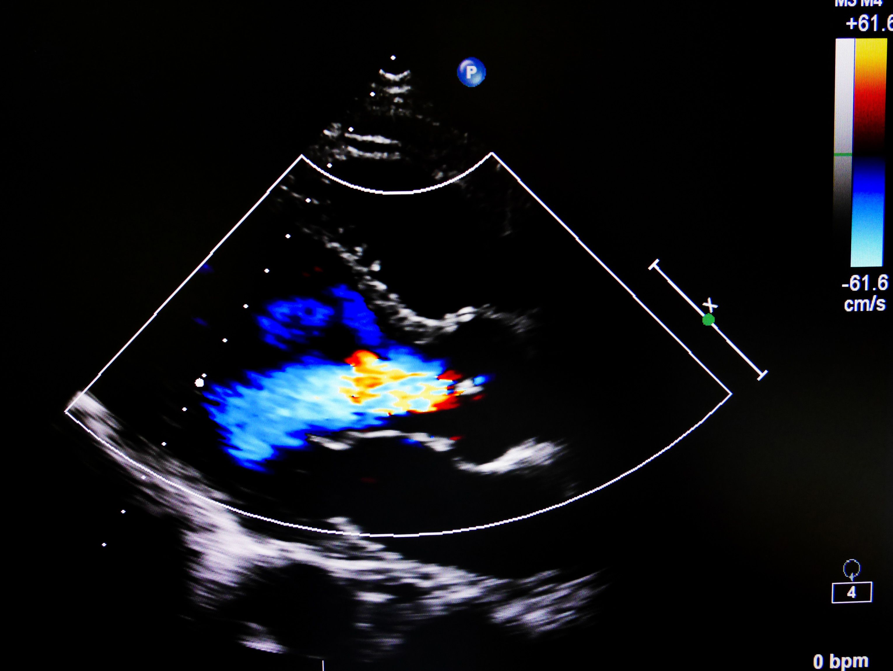 How To Prepare for an Ultrasound Properly?